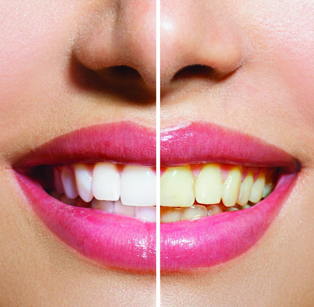 Teeth Whitening T Clinic Manchester Dentistry You Deserve